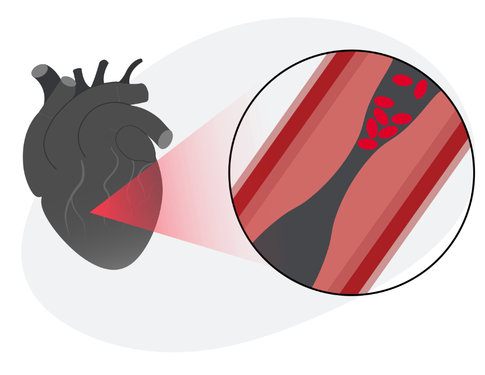 artery disease graphic