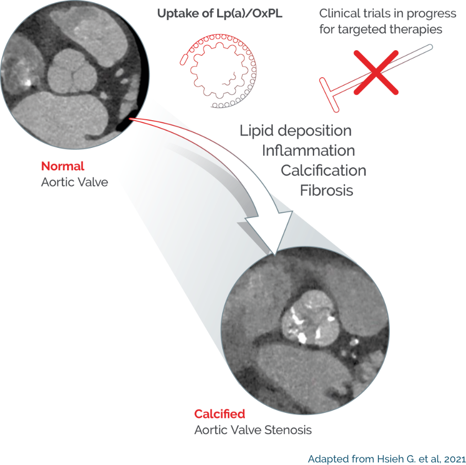 lpa calcified valve