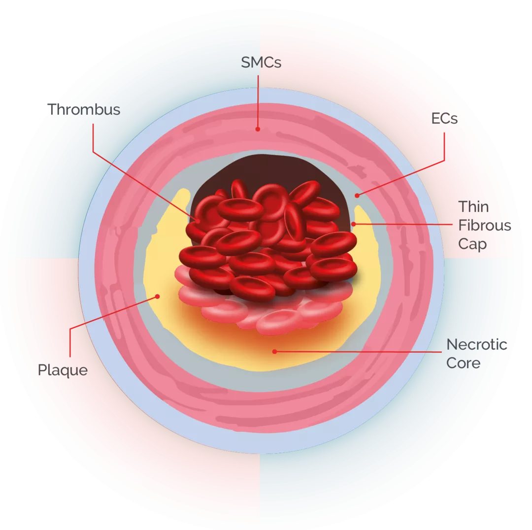 lpa plaque diagram
