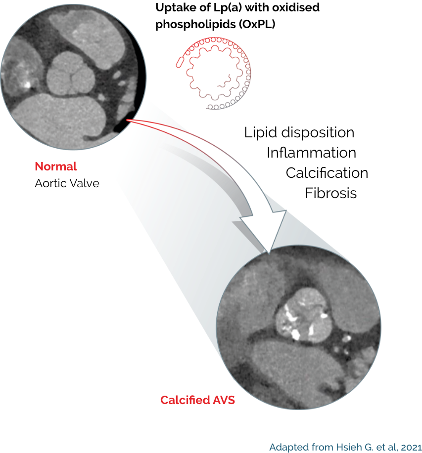 lpa normal vs calcified aortic valve graphic